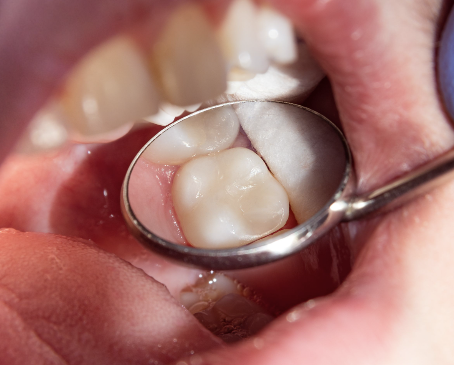 Dental fillings procedure at Grayson dental office